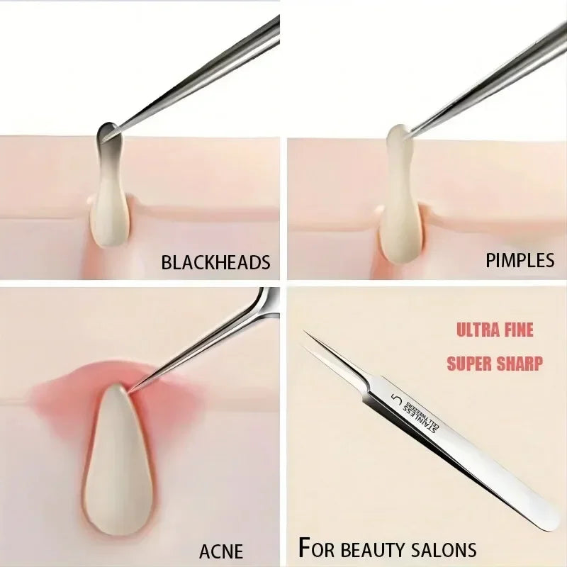 5 Cellular Blackhead Tweezers